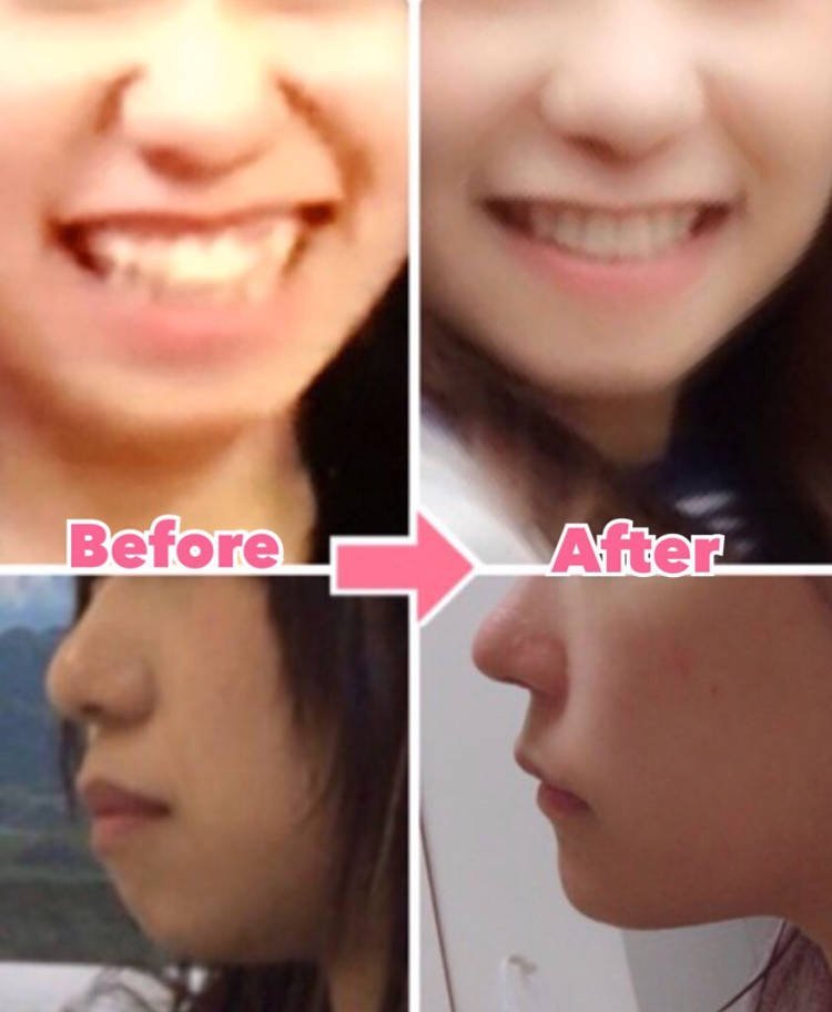 Mikishi-plastic-surgery3.jpg