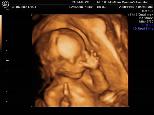 081115_별이입체초음파캡쳐 (4).jpg