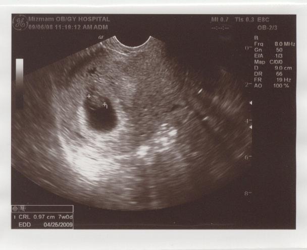 우리 아기 별 - 초음파사진02-7주 01.jpg