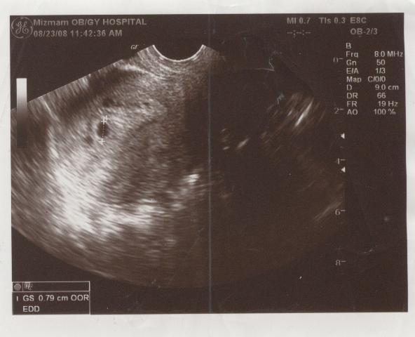 우리 아기 별 - 초음파사진01-5주.jpg