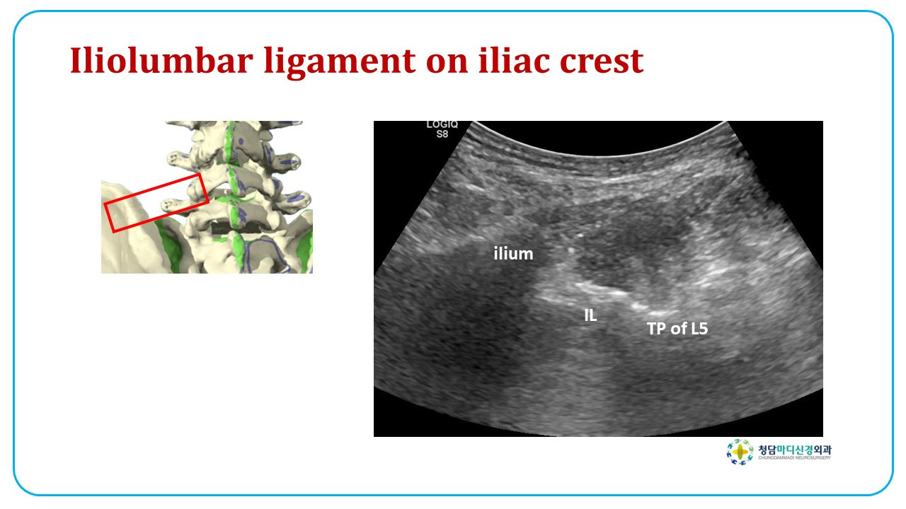2024-0329 허리 장요인대의 프롤로치료 방법.jpg