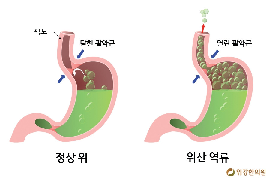역류성후두염1.jpg