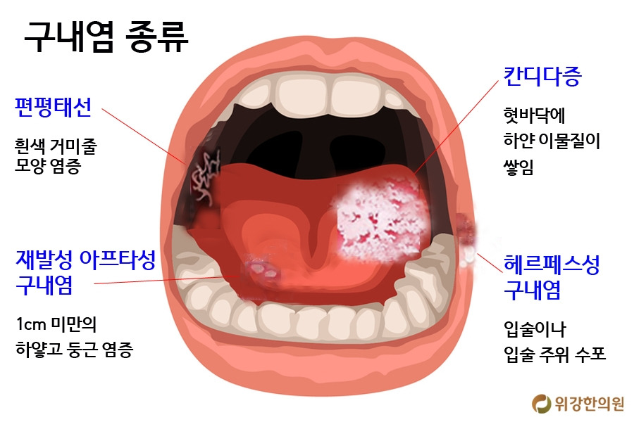 입안1.jpg