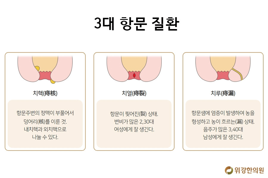 항문1.jpg