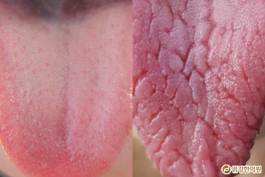 혓바닥갈라짐1.jpg
