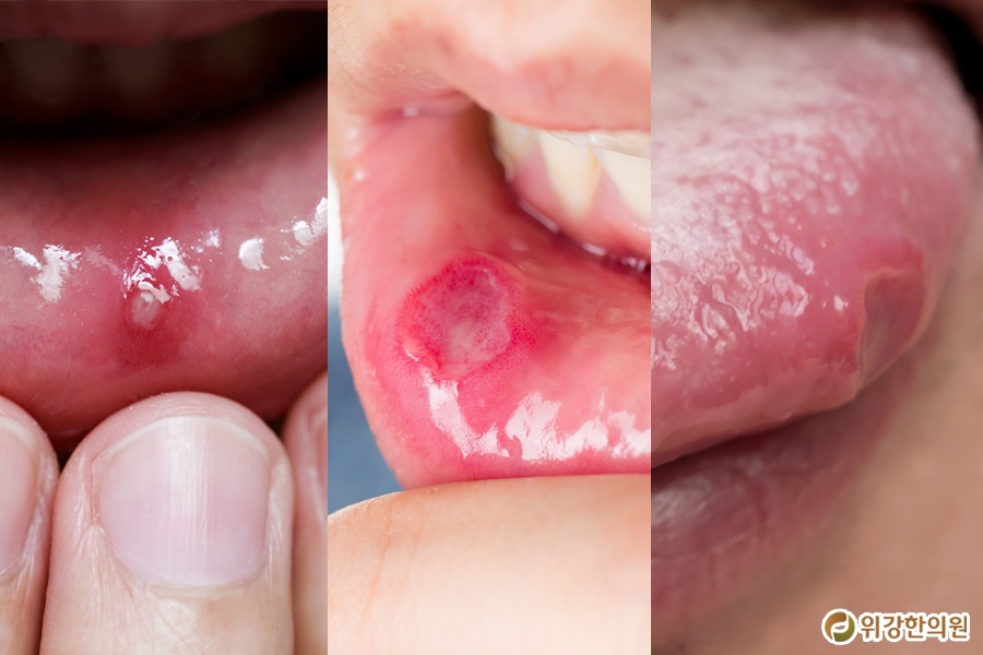 구내염빨리낫는법1.jpg