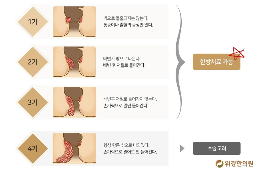치질1.jpg