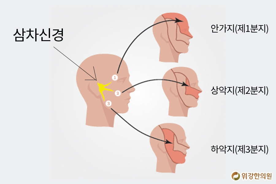 삼차신경통1.jpg