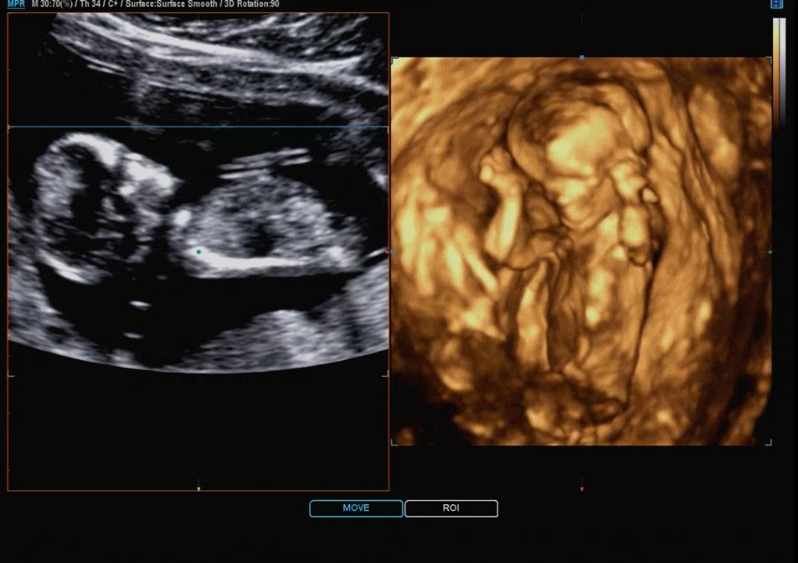 12주 입체초음파.jpg