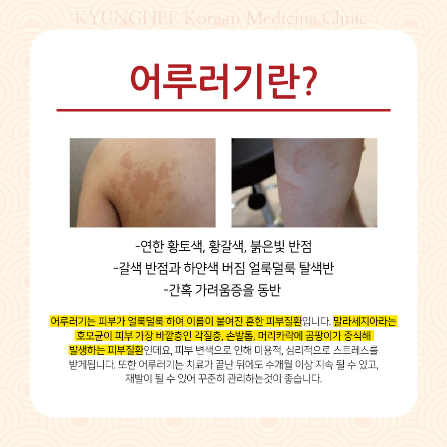 230706_어루러기-치료-한의원02.jpg
