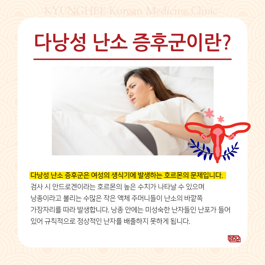 230329_다낭성난소증후군02.jpg