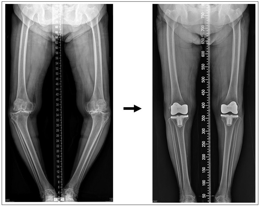 심한varus 정정순 술전(595471). (1)....jpg
