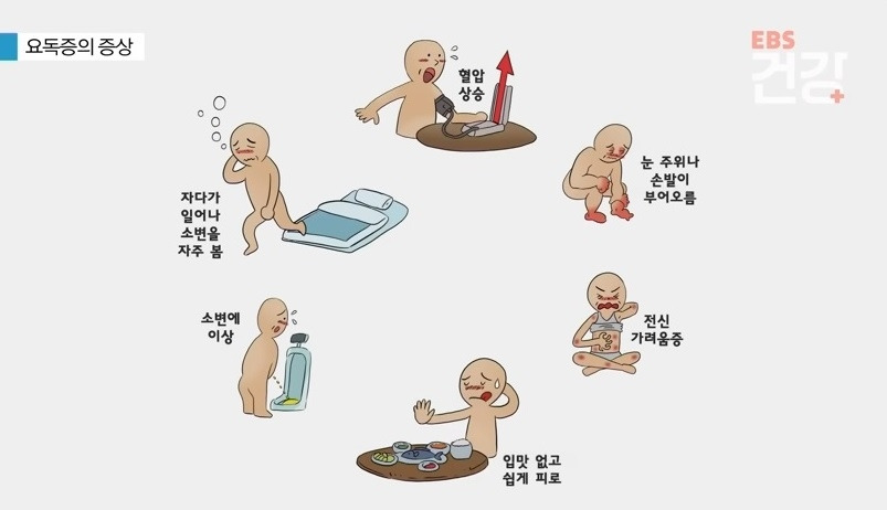 요독증증상EBS...jpg