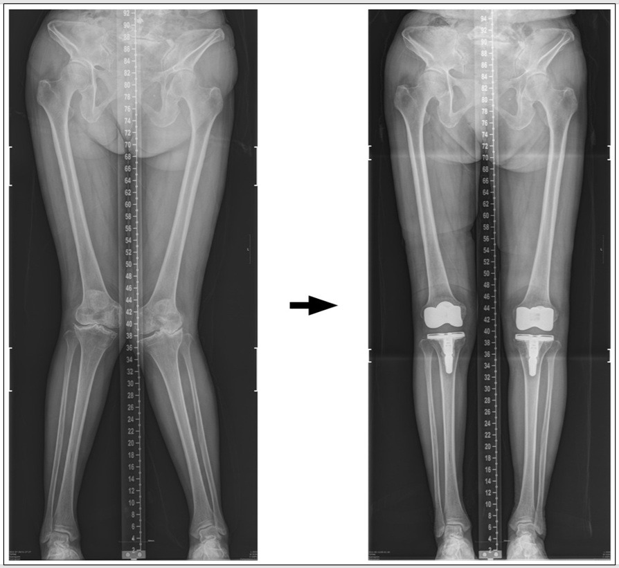 심한 valgus 김영숙 술후.......jpg
