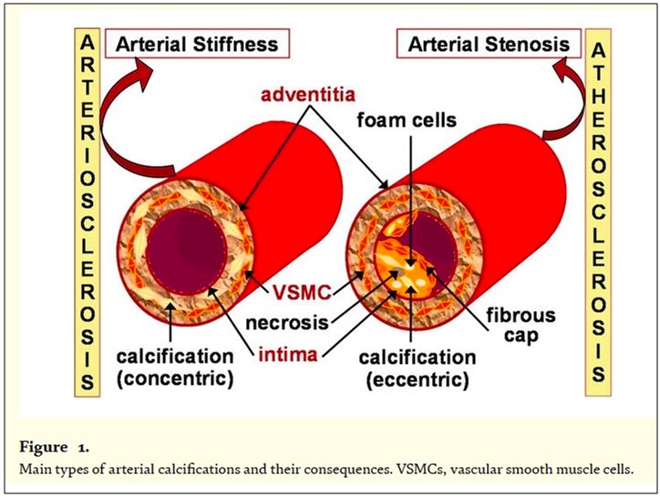 vascular calcification...jpg