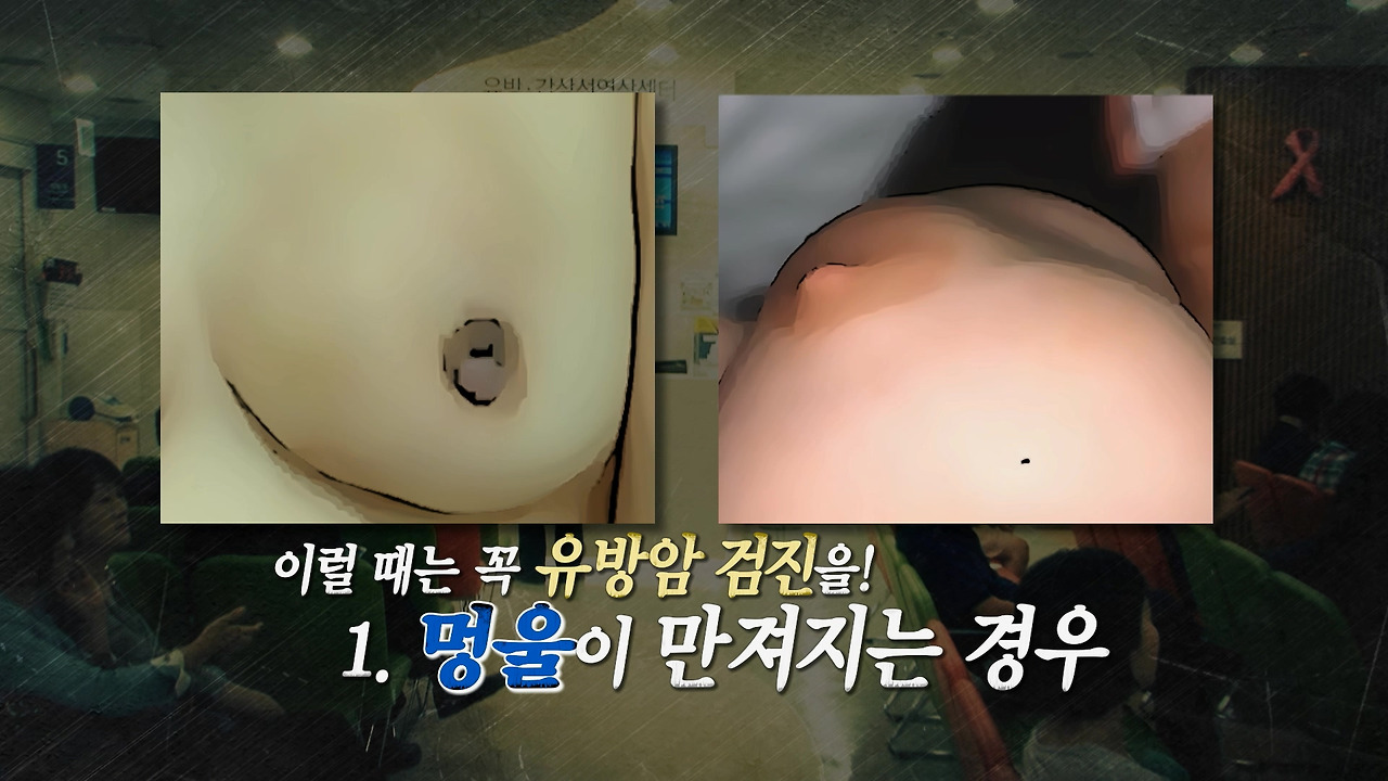 유방암 의심단계1.jpg