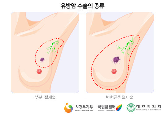 유방암수술.jpg