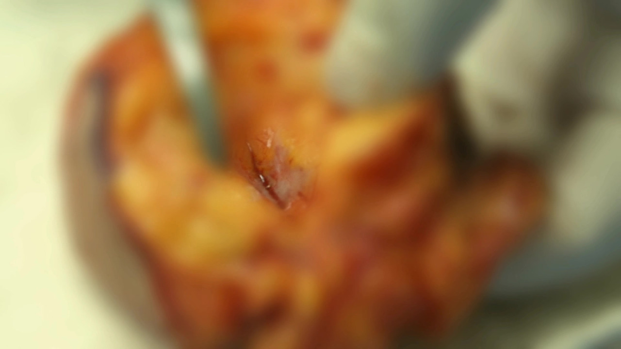 유방암 종양.jpg