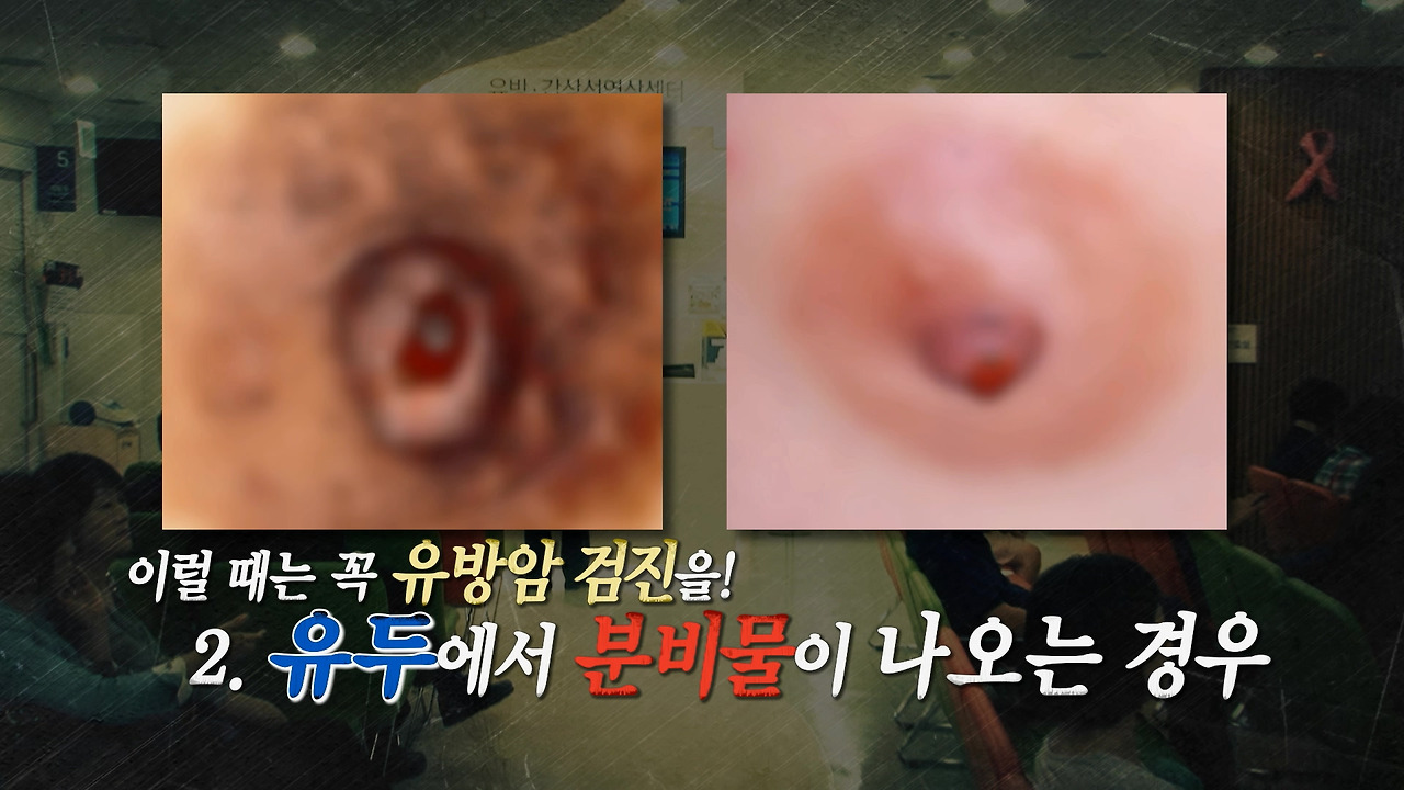 유방암 의심단계2.jpg