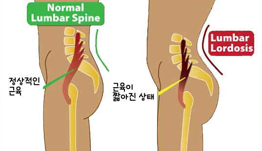 허리디스크 장요근 재활운동방법 앉으면 허리가 아파요2.jpg