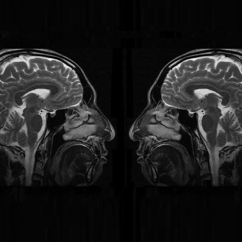 뇌 앞쪽 뒷쪽.jpg