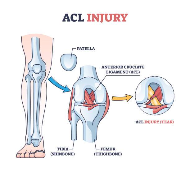 ACL INJURY.jpg