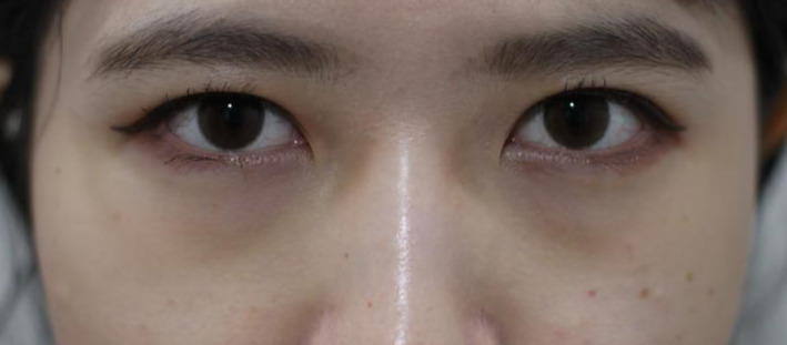 2020-05-22 이마,볼정면,턱 표층4.jpg