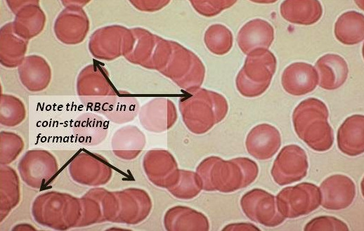 Coin-Stacking-RBC-Rouleaux-formation.jpg