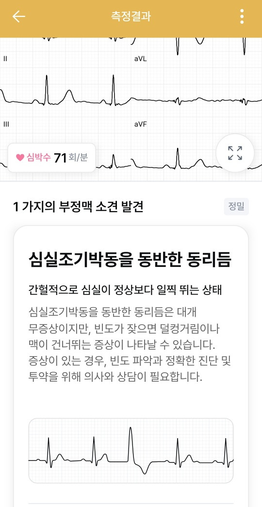 심실조기수축.jpg