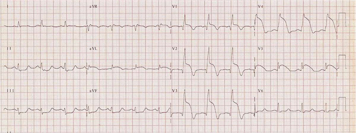 EC-Proximal-LAD-Acute-anteroseptal-STEMI.jpg