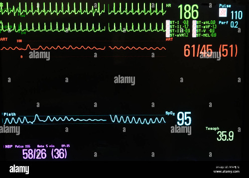 monitor-showing-supraventricular-tachycardia-in-green-arterial-blood-pressure-in-red-pulse-oximetry-in-blue-noninvasive-blood-pressure-in-lavender-MAHJ72.jpg