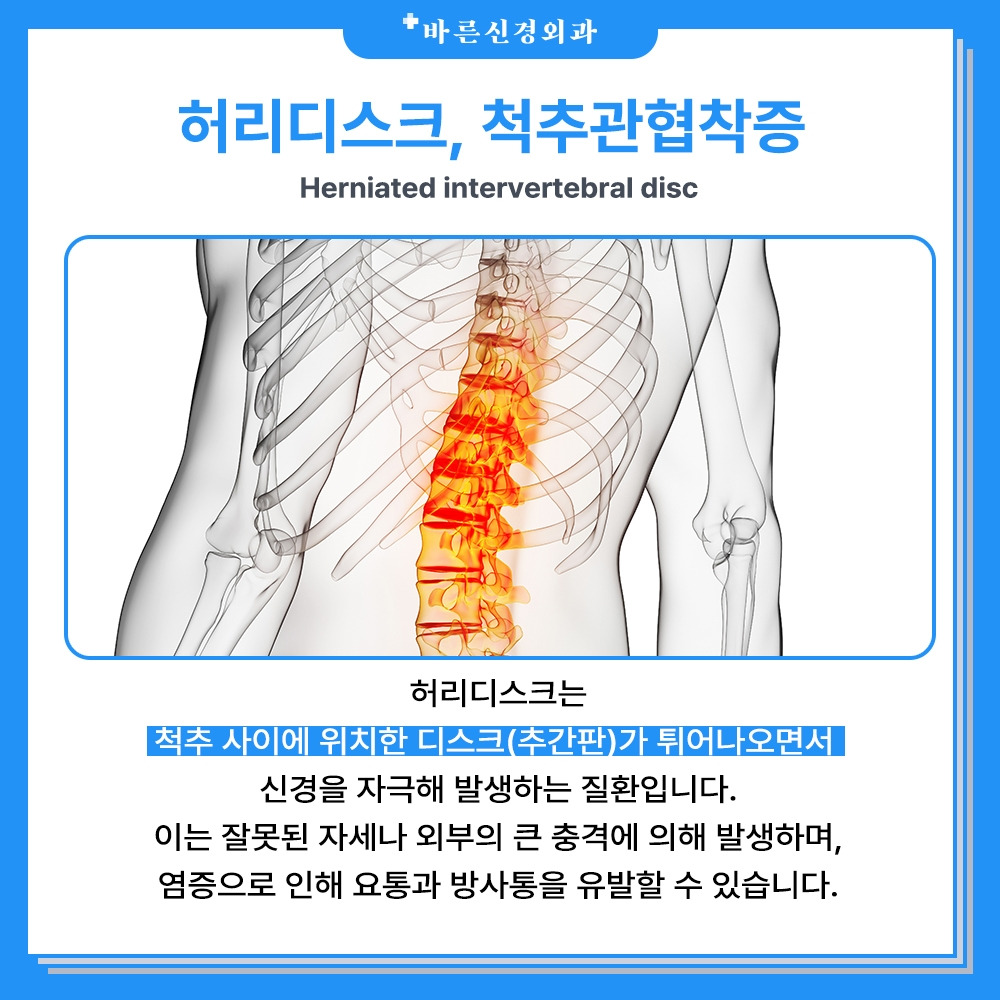 허리디스크 (6).jpg