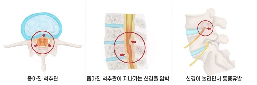 아픈-척추관-1-1024x341.jpg