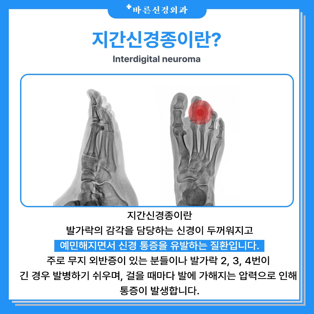 지간신경종이란 (1).jpg