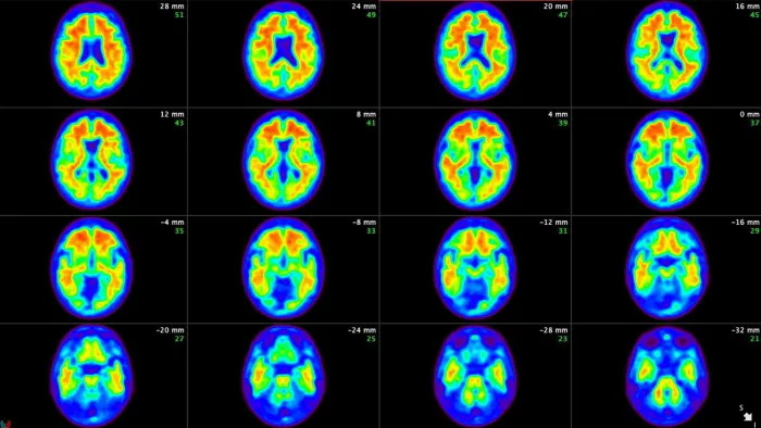 Alzheimer's brain scan.jpg