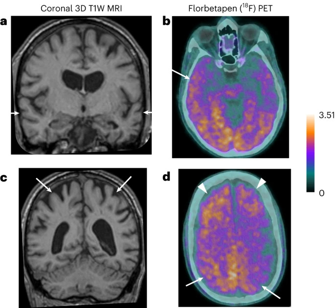 Dementia MRI and PET-Scan.jpg