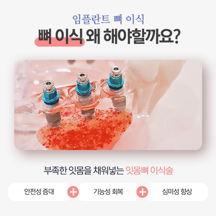 임플란트5.jpg