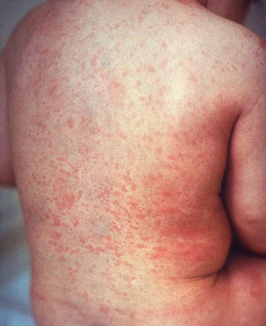 Rash_of_rubella_on_back_(crop).jpg
