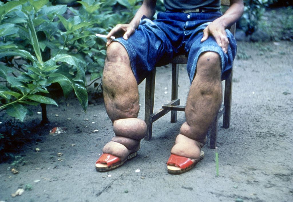 1024px-Elephantiasis.jpg