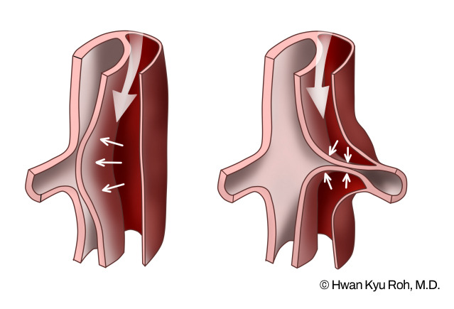 aortic dissection side effects.jpg
