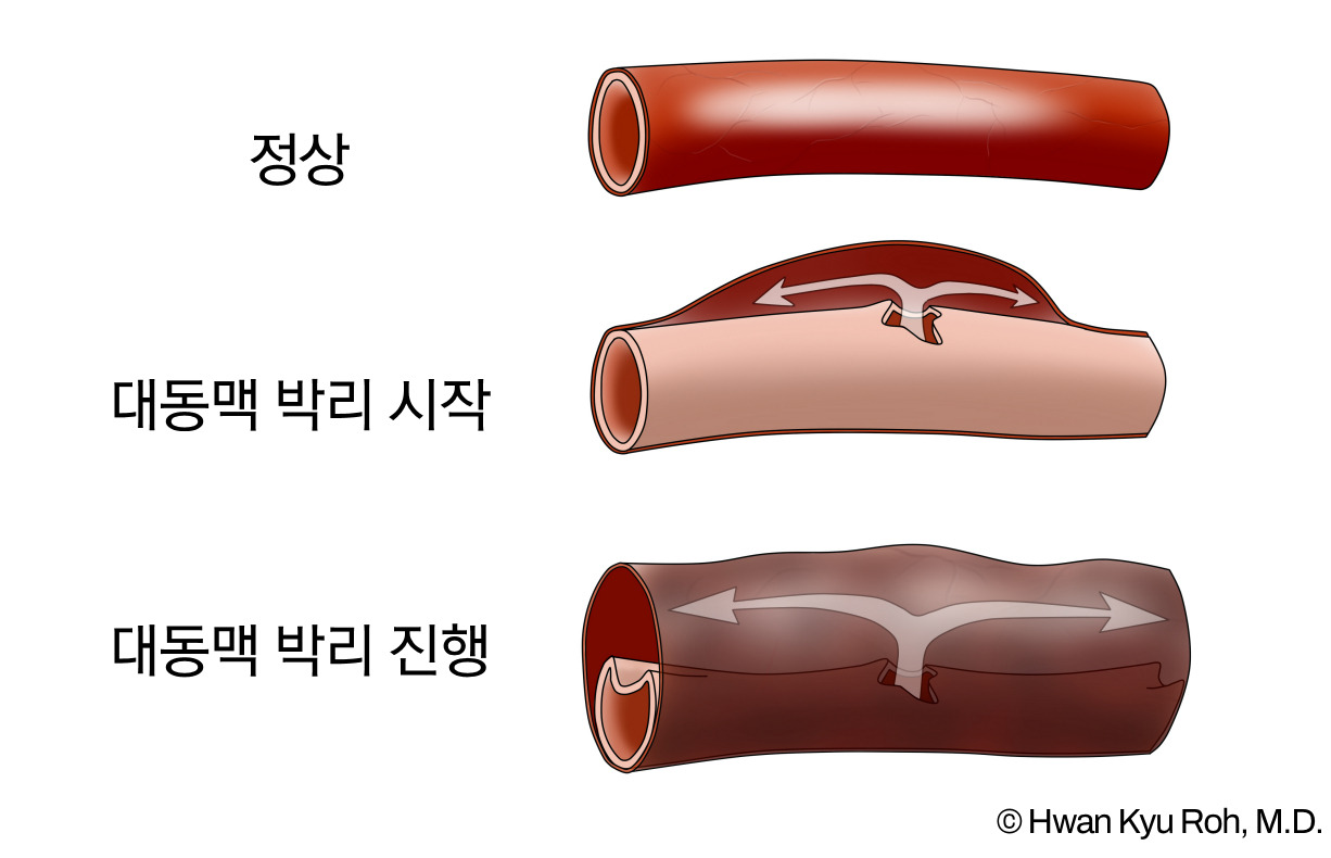 AORTIC DISSECTION.jpg