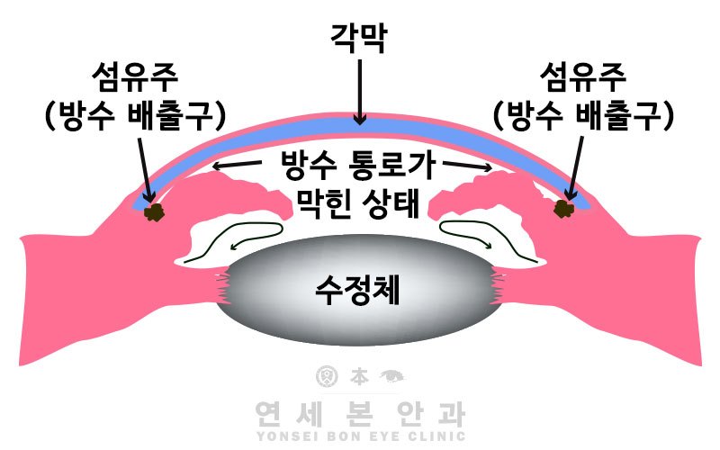 방수-배출구가-막힌-상태.jpg