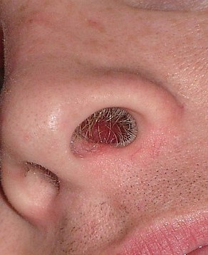 콧털- Nasal_hair - Wikipedia.jpg