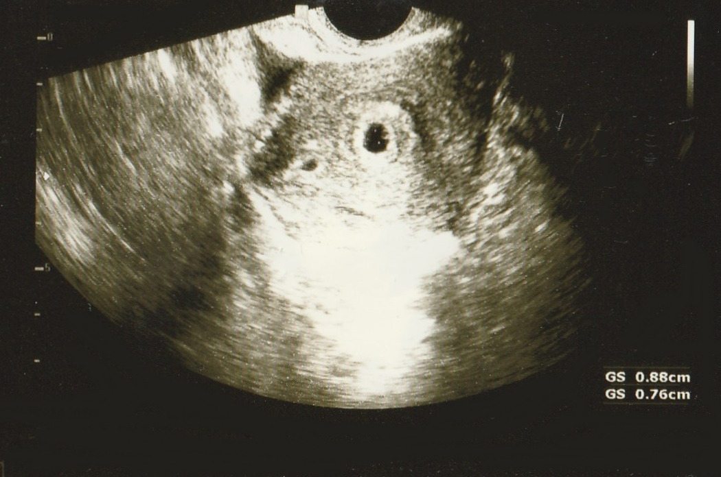 한새연우 초음파사진1.jpg