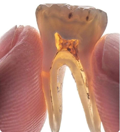 치아 뼈.jpg