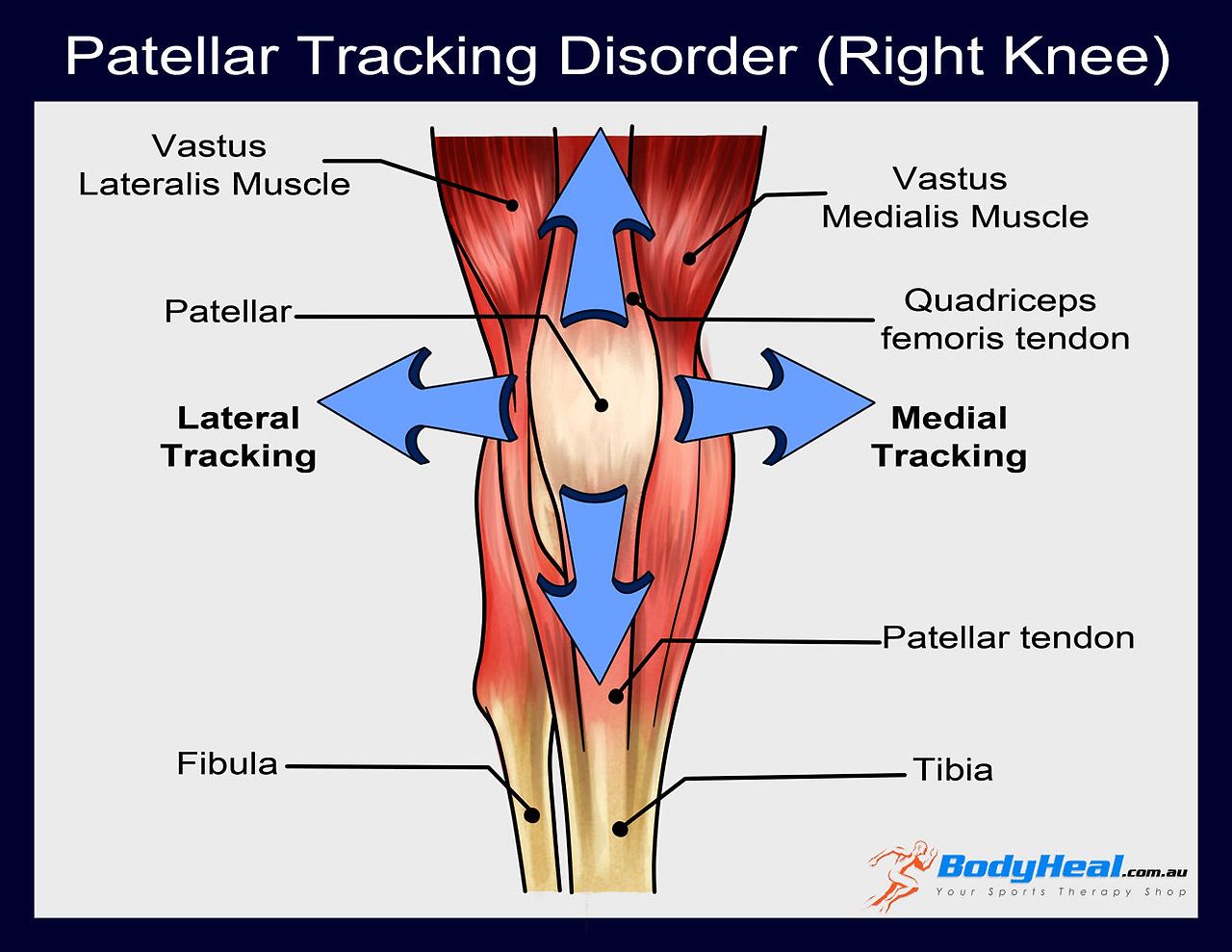 patellar-tracking-disorder.jpg