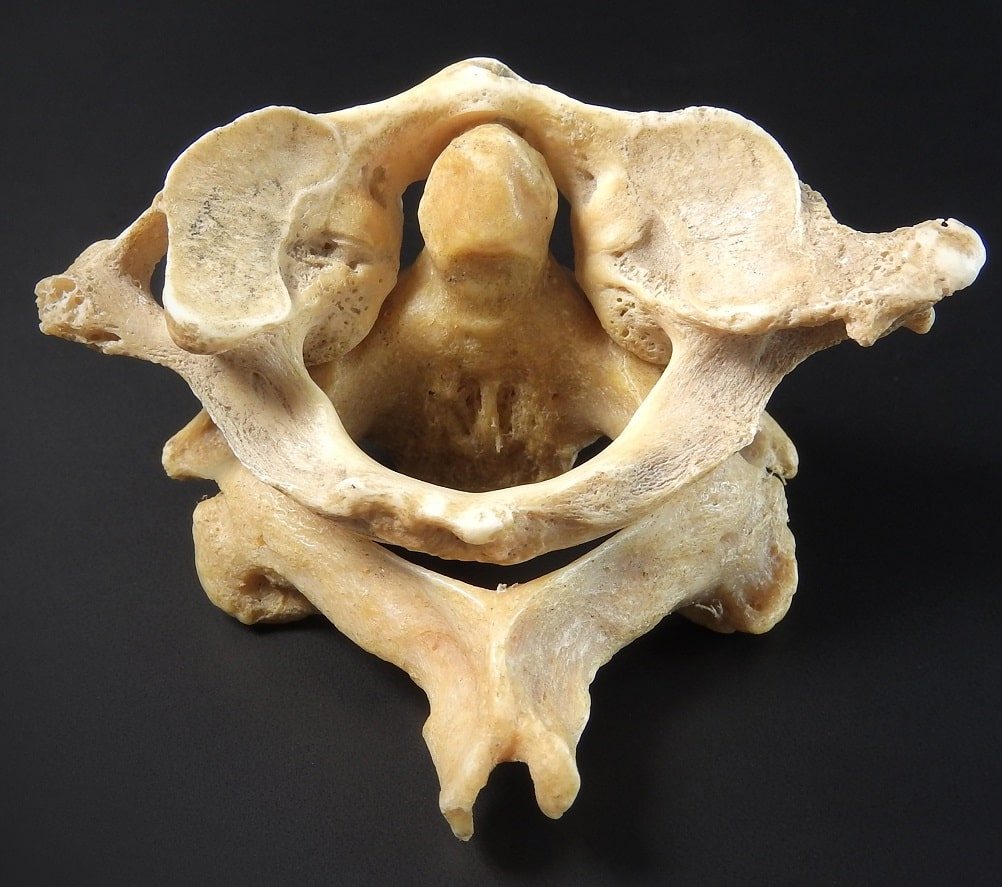 Atlantoaxial_joint.jpg