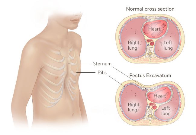 pectus-excavatum-A.jpg