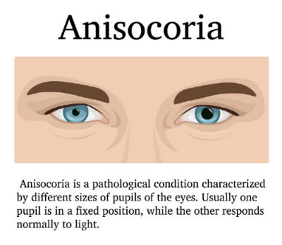 Anisocoria_01.jpg