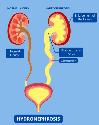 Hydronephrosis_01.jpg
